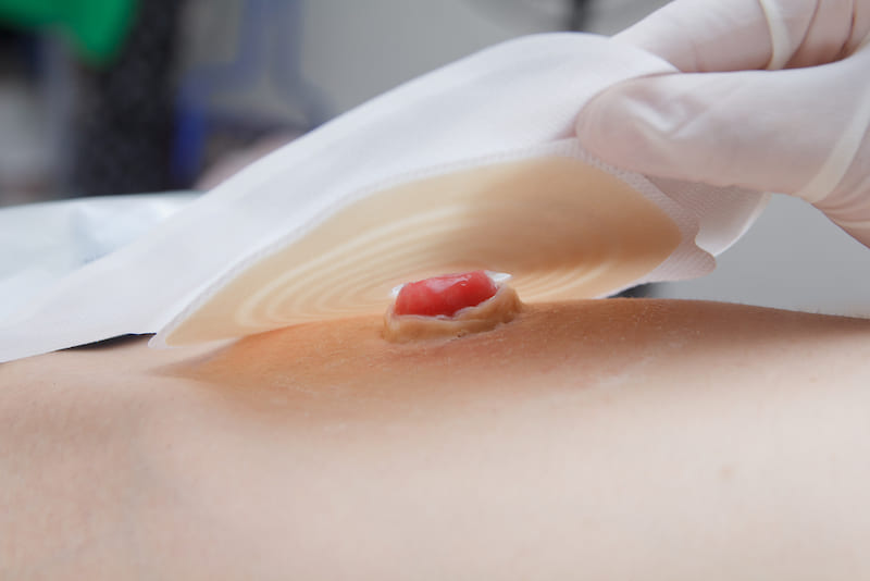 Assisting with Ostomy Care