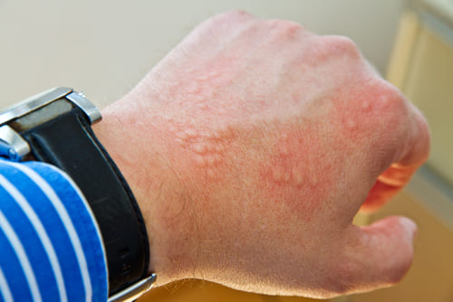 Common Skin Conditions<