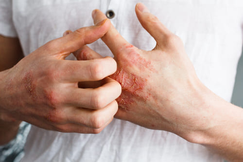 Caring for Skin<