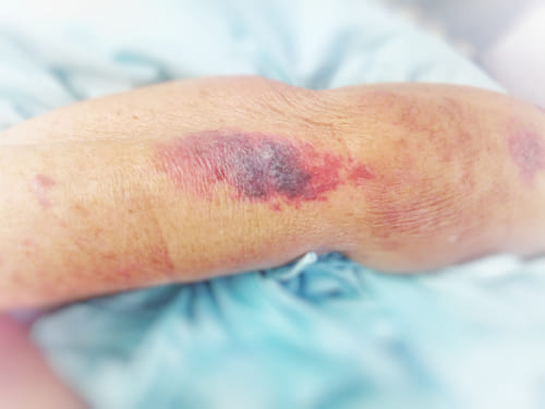 Pressure Injuries<