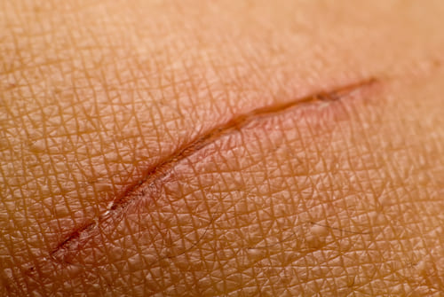 Skin Tears<