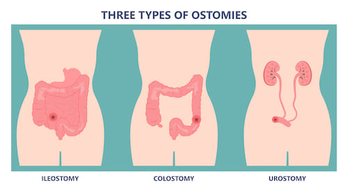 What is an Ostomy<
