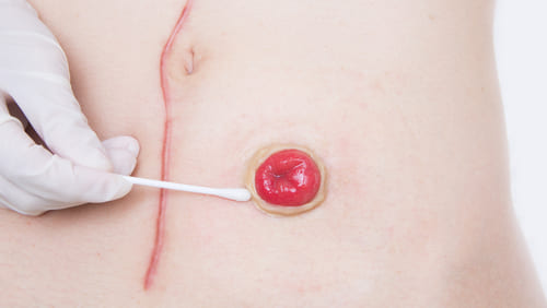 Ostomy Problems<